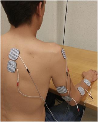 The Use of Functional Electrical Stimulation on the Upper Limb and Interscapular Muscles of Patients with Stroke for the Improvement of Reaching Movements: A Feasibility Study